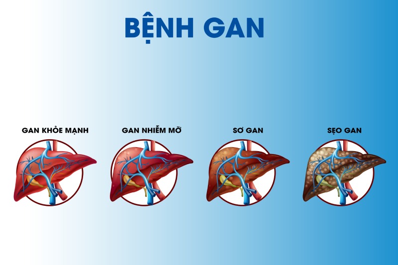 biến chứng gan nhiễm mỡ độ 2