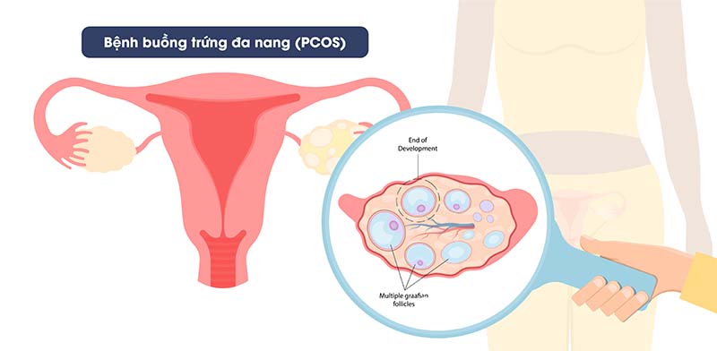bệnh buồng trứng đa nang gây rụng tóc