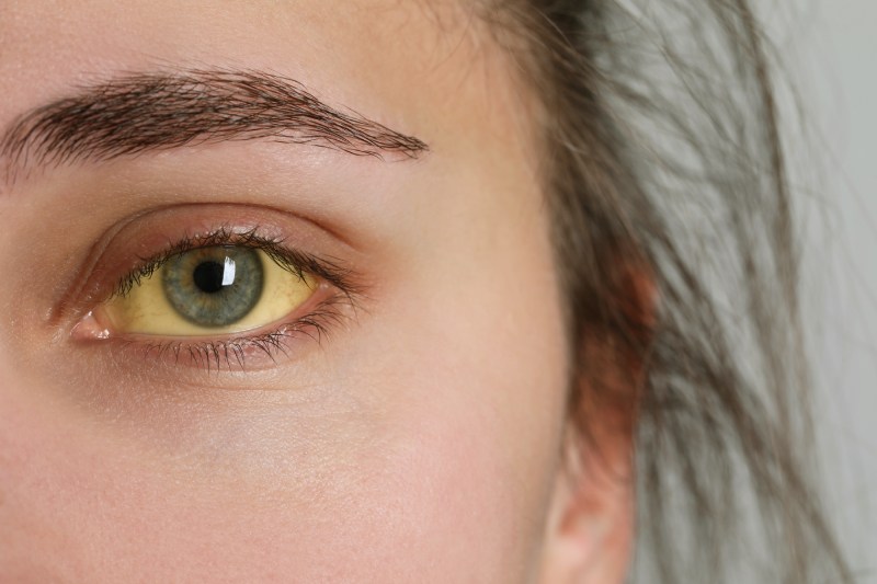 triệu chứng gan nhiễm mỡ độ 3