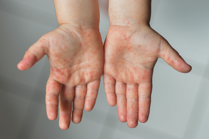 bệnh do virus enterovirus gây ra các mụn nước ở tay chân miệng
