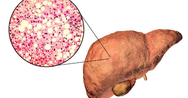 bệnh gan nhiễm mỡ
