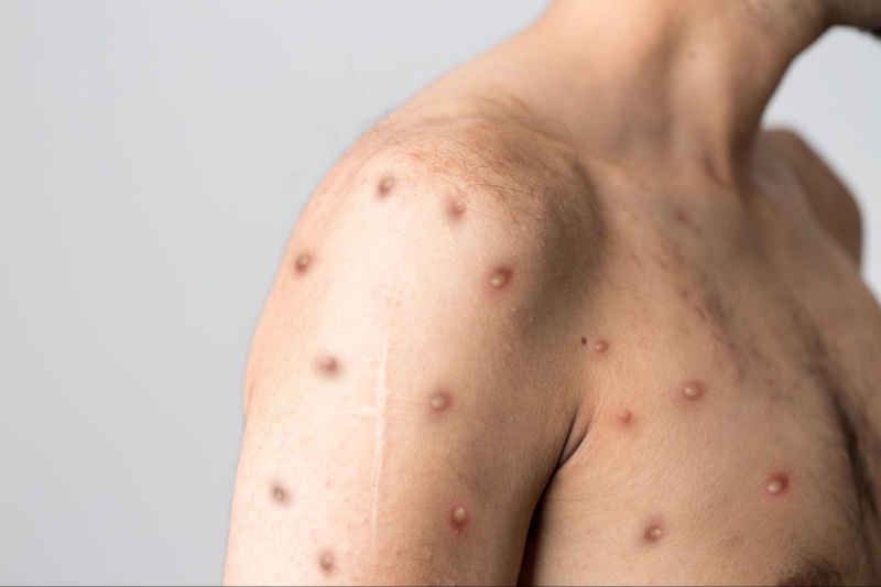 bệnh lây nhiễm nhóm a - đậu mùa