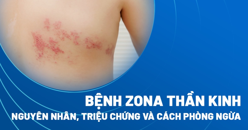 bệnh zona thần kinh