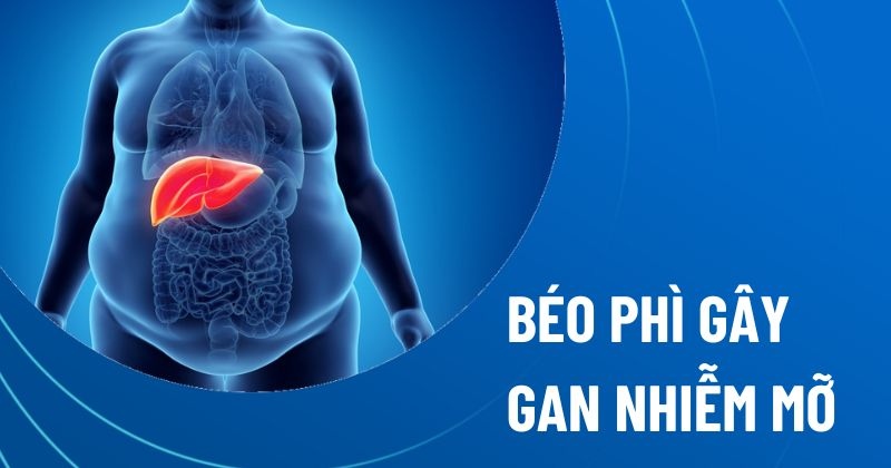 béo phì gây gan nhiễm mỡ