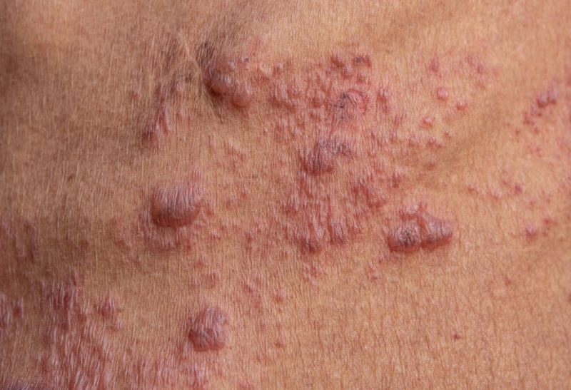 bị giời ăn có các mụn nước