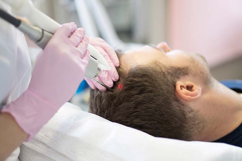 điều trị rụng tóc bằng laser
