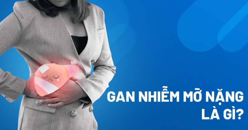 gan nhiễm mỡ nặng