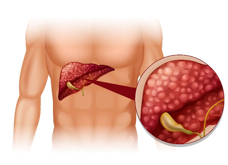 mắc bệnh gan nhiễm mỡ 