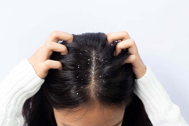 nữ giới bị gàu gây ngứa