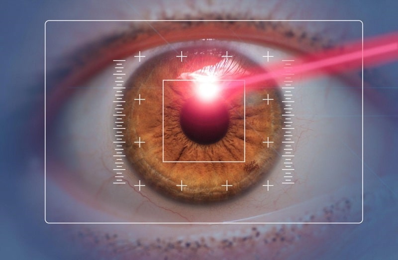 Phẫu thuật Lasik
