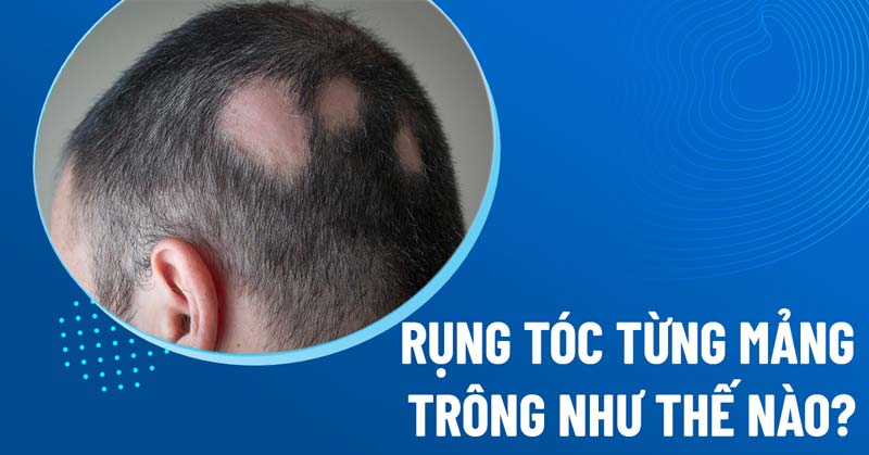 rụng tóc từng mảng