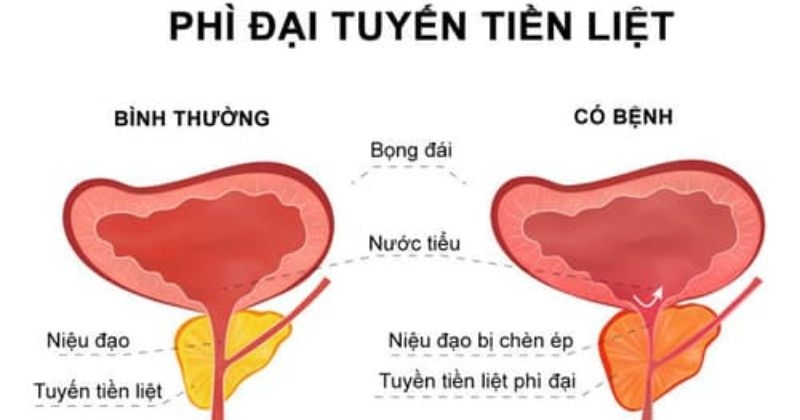chỉ định sử dụng thuốc alfuzosin