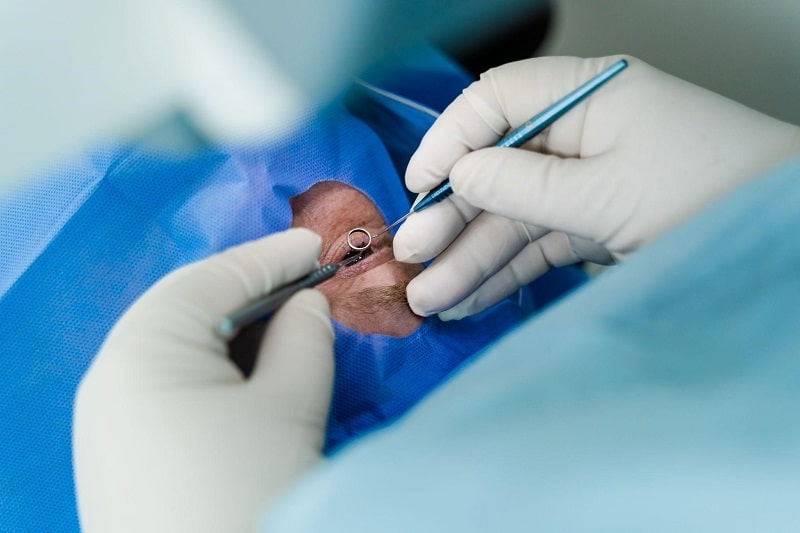 Điều kiện để thực hiện bắn mắt cận thị