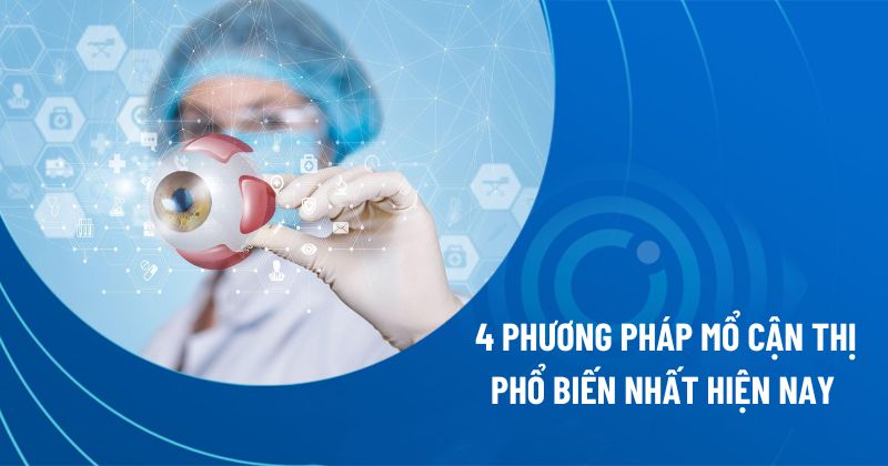 mổ mắt cận thị