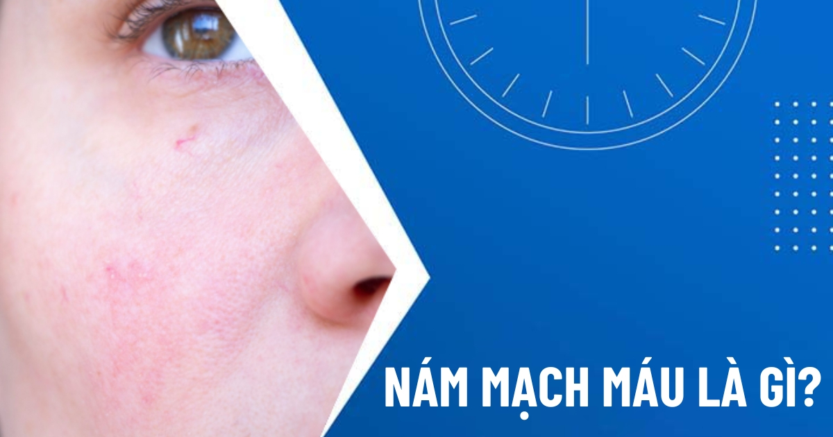 Nám mạch máu là gì và cách khắc phục