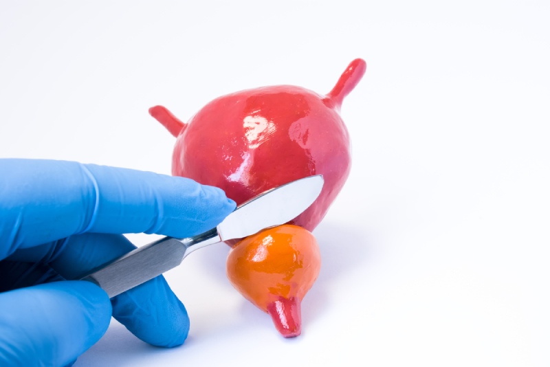 phẫu thuật tuyến tiền liệt