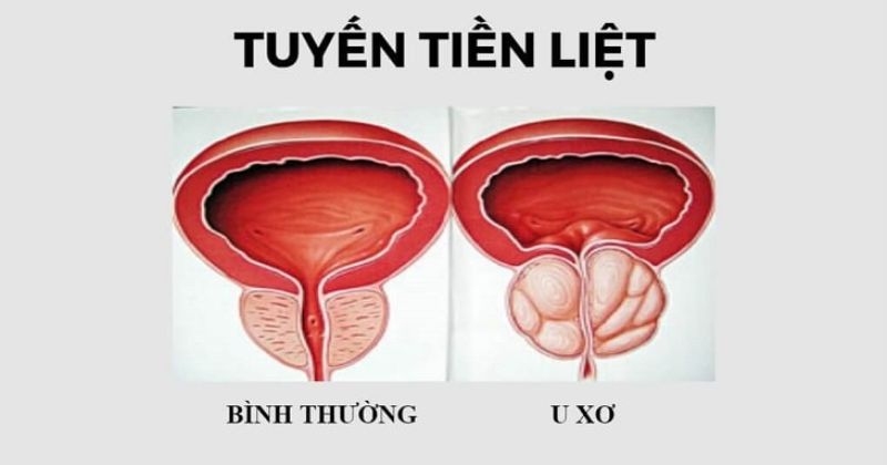 tác dụng của thuốc alfuzosin