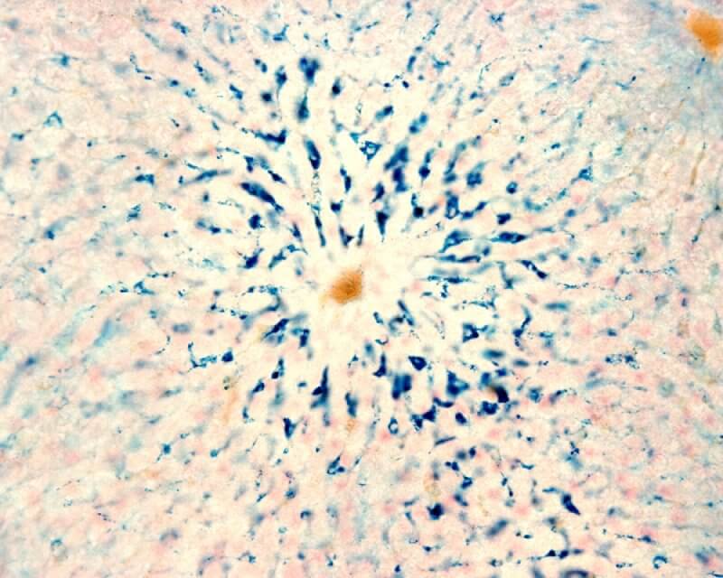 tế bào kupffer bị kích hoạt quá mức