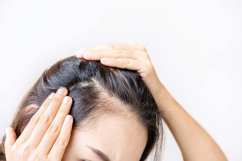 tóc rụng nhìn thấy da đầu