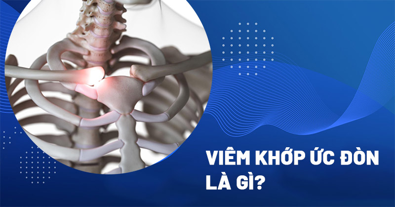 Viêm khớp ức đòn