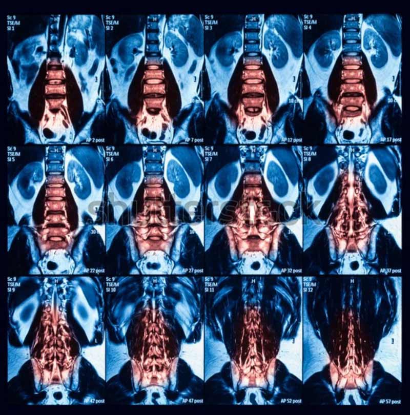 Chẩn đoán viêm khớp cùng chậu
