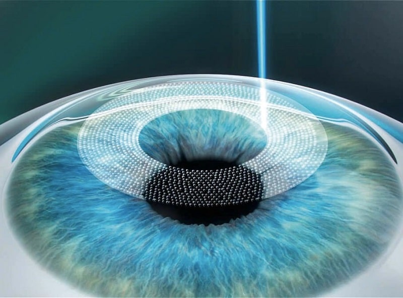 Đánh giá 2 phương pháp phẫu thuật