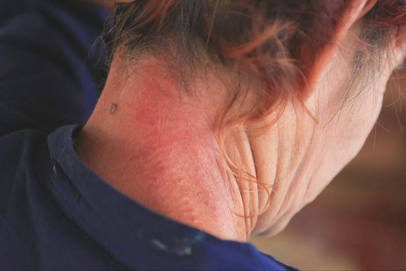 lupus ban đỏ