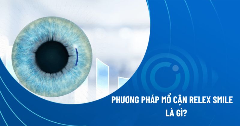 Phương pháp mổ cận Relex Smile
