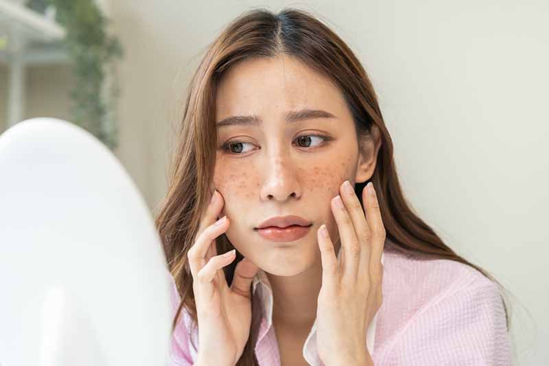 Nám nội tiết là gì?
