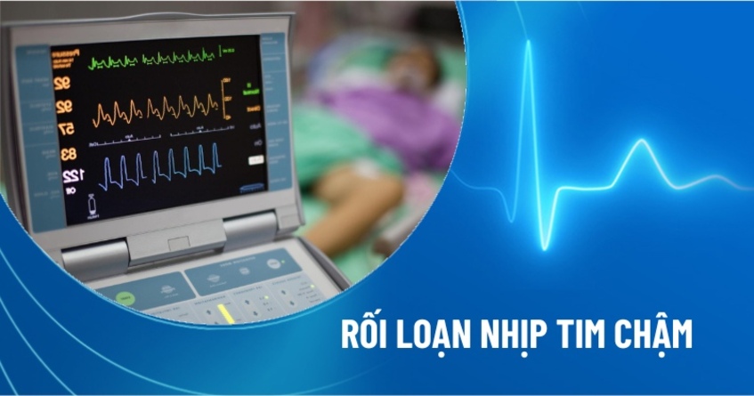 Rối loạn nhịp tim chậm: Nguyên nhân, triệu chứng và điều trị