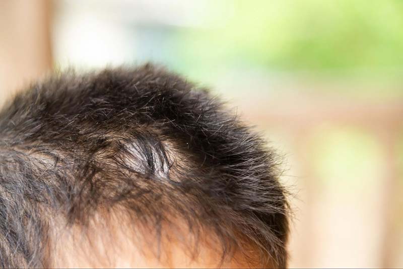 rụng tóc ở chỗ sẹo