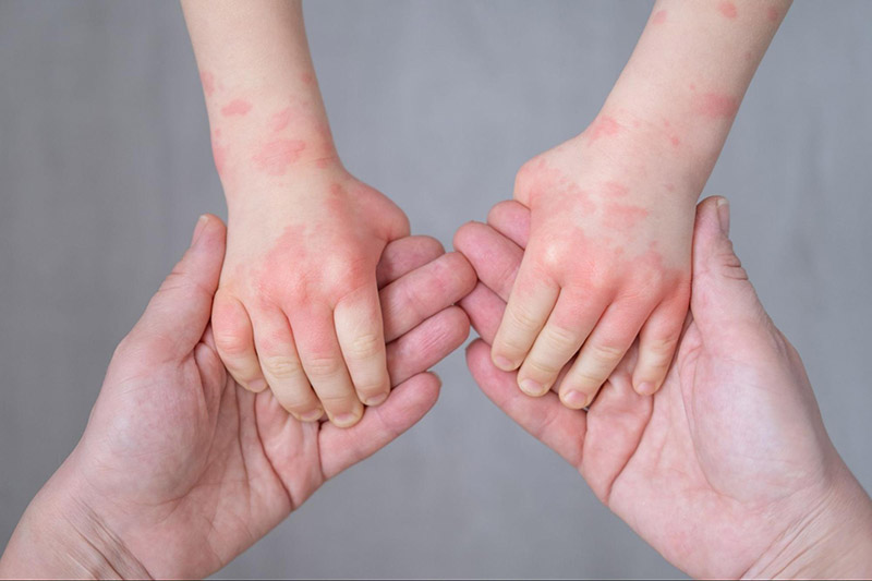 Viêm khớp thiếu niên hệ thống