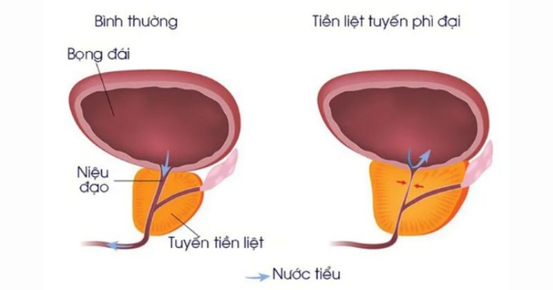 xatral xl được chỉ định điều trị tăng sản tuyến tiền liệt