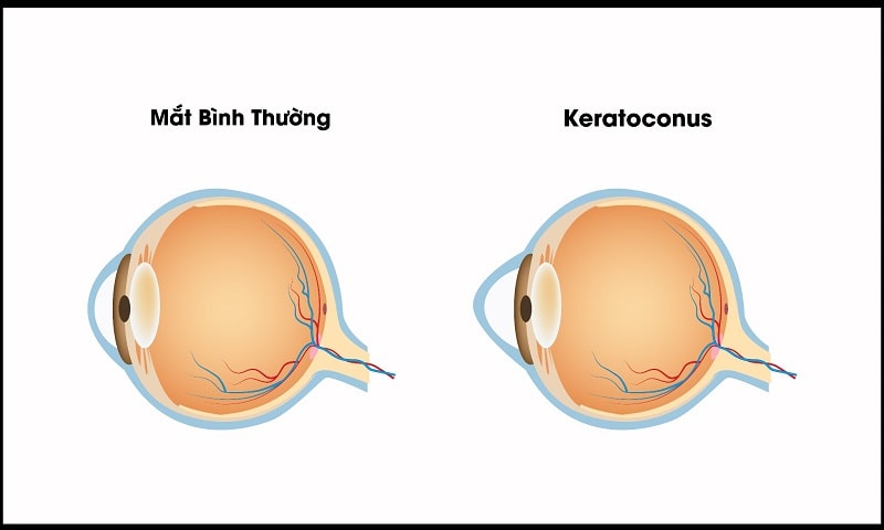 Lựa chọn phương pháp mổ cận phù hợp