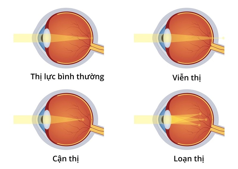 Nguyên lý hoạt động của phương pháp Lasik