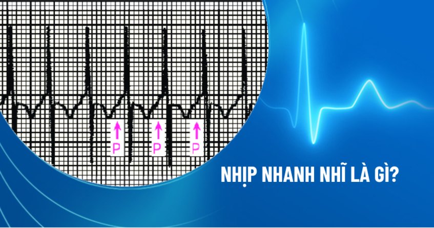 Nhịp nhanh nhĩ: Nguyên nhân, triệu chứng, chẩn đoán, phòng ngừa