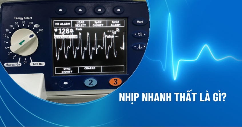 Nhịp nhanh thất: Nguyên nhân, triệu chứng, chẩn đoán, phòng ngừa