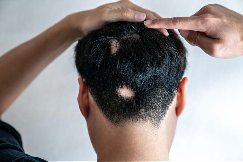 tóc rụng thành từng mảng