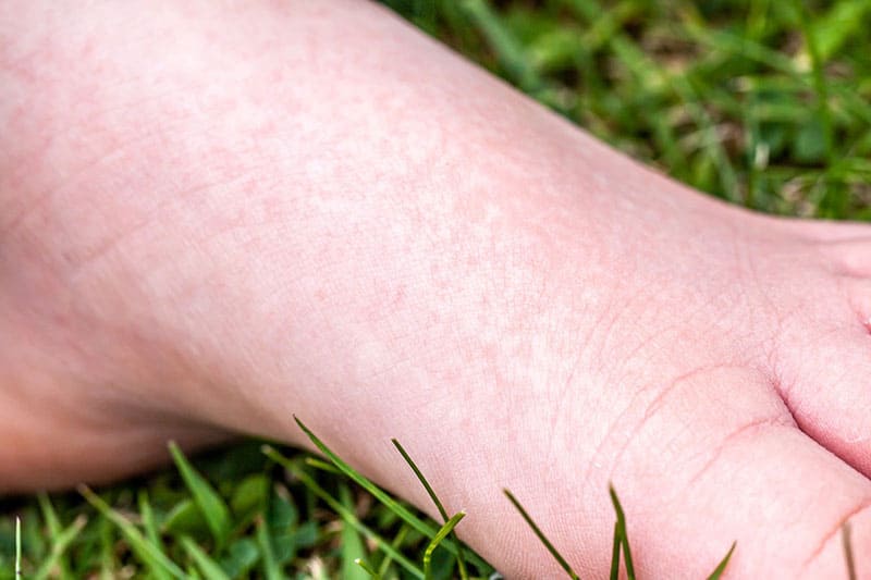 Bị bệnh ban đỏ không nên sử dụng đông trùng hạ thảo