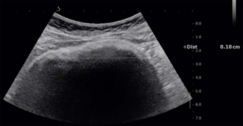 búi tóc lớn trong dạ dày qua hình ảnh siêu âm