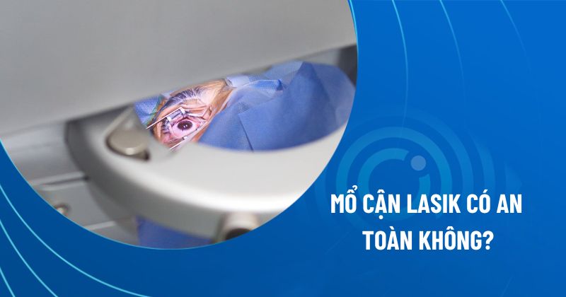 Mổ cận Lasik có an toàn không