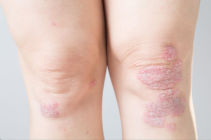 Nguyên nhân gây bệnh viêm khớp vảy nến