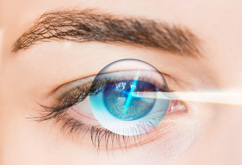 Phương pháp Smile