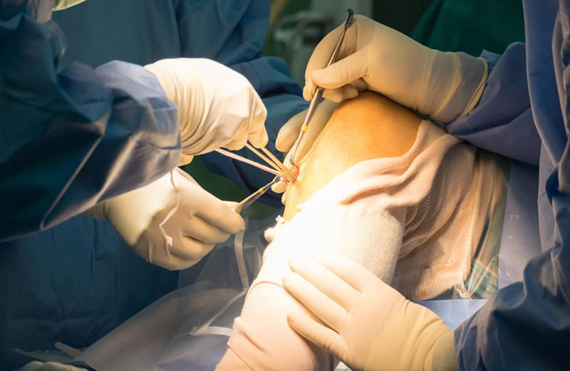 Phẫu thuật điều trị viêm khớp liên cầu