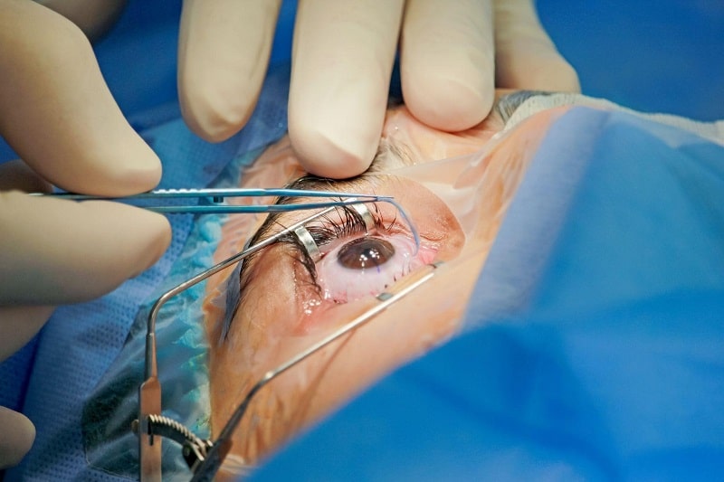 Phương pháp mổ mắt Lasik là gì?