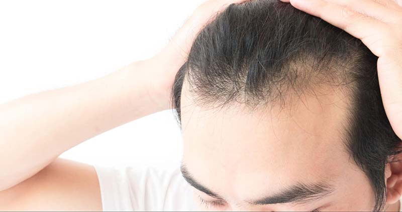 Hormone DHT gây rụng tóc như thế nào? Làm sao để giảm tác hại?