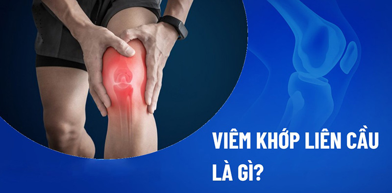 Viêm khớp liên cầu