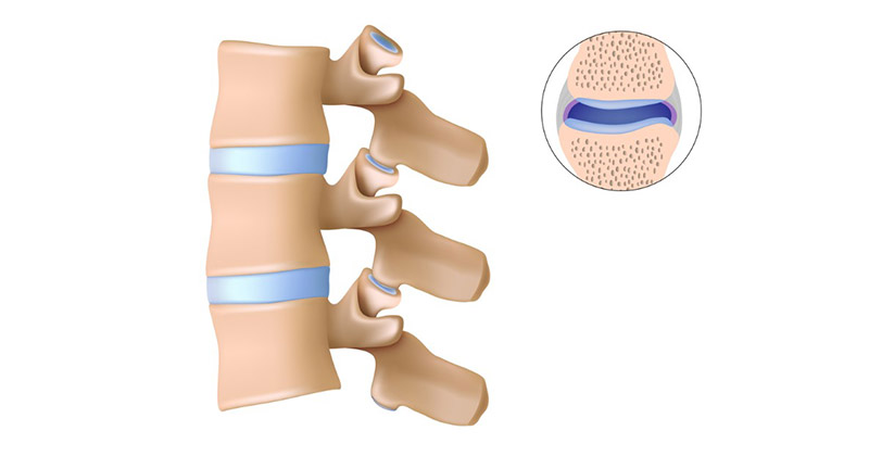 Viêm khớp liên mấu cột sống
