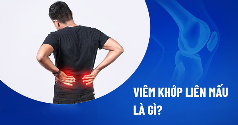 Viêm khớp liên mấu