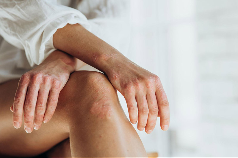 Viêm khớp vảy nến là bệnh tự miễn